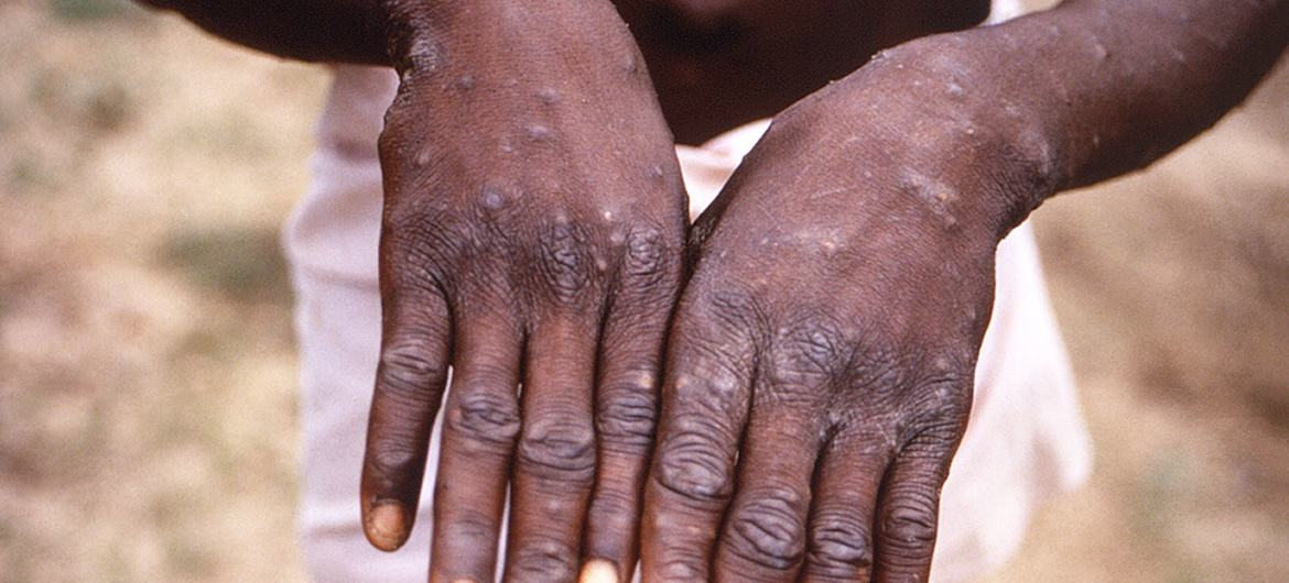 Minimal risk of monkeypox transmission in UK following confirmed case | |  UN News